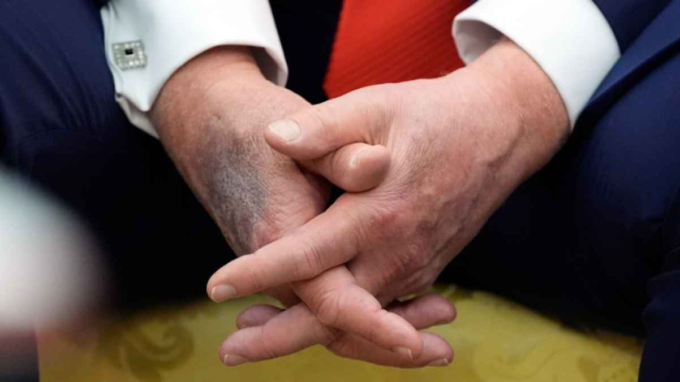 ظُهُورُ الكَدَمَاتِ عَلَى يَدِ تَرَمْب يُعِيدُ إِشْعَالَ التَّكَهُّنَاتِ حَوْلَ صِحَّتِهِ#ظهور #الكدمات #على #يد #ترمب #يعيد #إشعال #التكهنات #حول #صحته