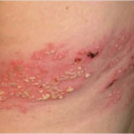 مناعة الحزام الناري قد لا تستمر أكثر من عامين#مناعة #الحزام #الناري #قد #لا #تستمر #أكثر #من #عامين