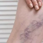 أوجاع الساقين.. علامة خفية تحذر من خطر داهم يستوجب التدخل الجراحي الفوري#أوجاع #الساقين. #علامة #خفية #تحذر #من #خطر #داهم #يستوجب #التدخل #الجراحي #الفوري