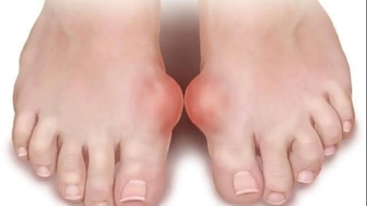 علامة واحدة في قدمك.. النقرس ينهي صمت سنوات ويكشف أسرار المرض.#علامة #واحدة #في #قدمك. #النقرس #ينهي #صمت #سنوات #ويكشف #أسرار #المرض