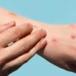 نتائج إيجابية.. مراجعة بيانات سلامة أبحاث علاج جدري القرود في أفريقيا تُحرز تقدماً#نتائج #إيجابية. #مراجعة #بيانات #سلامة #أبحاث #علاج #جدري #القرود #في #أفريقيا #تحرز #تقدما