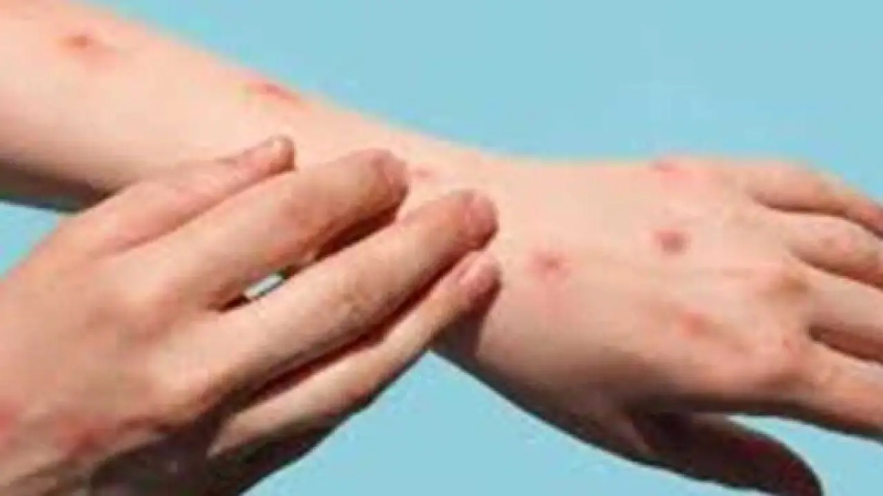 نتائج إيجابية.. مراجعة بيانات سلامة أبحاث علاج جدري القرود في أفريقيا تُحرز تقدماً#نتائج #إيجابية. #مراجعة #بيانات #سلامة #أبحاث #علاج #جدري #القرود #في #أفريقيا #تحرز #تقدما